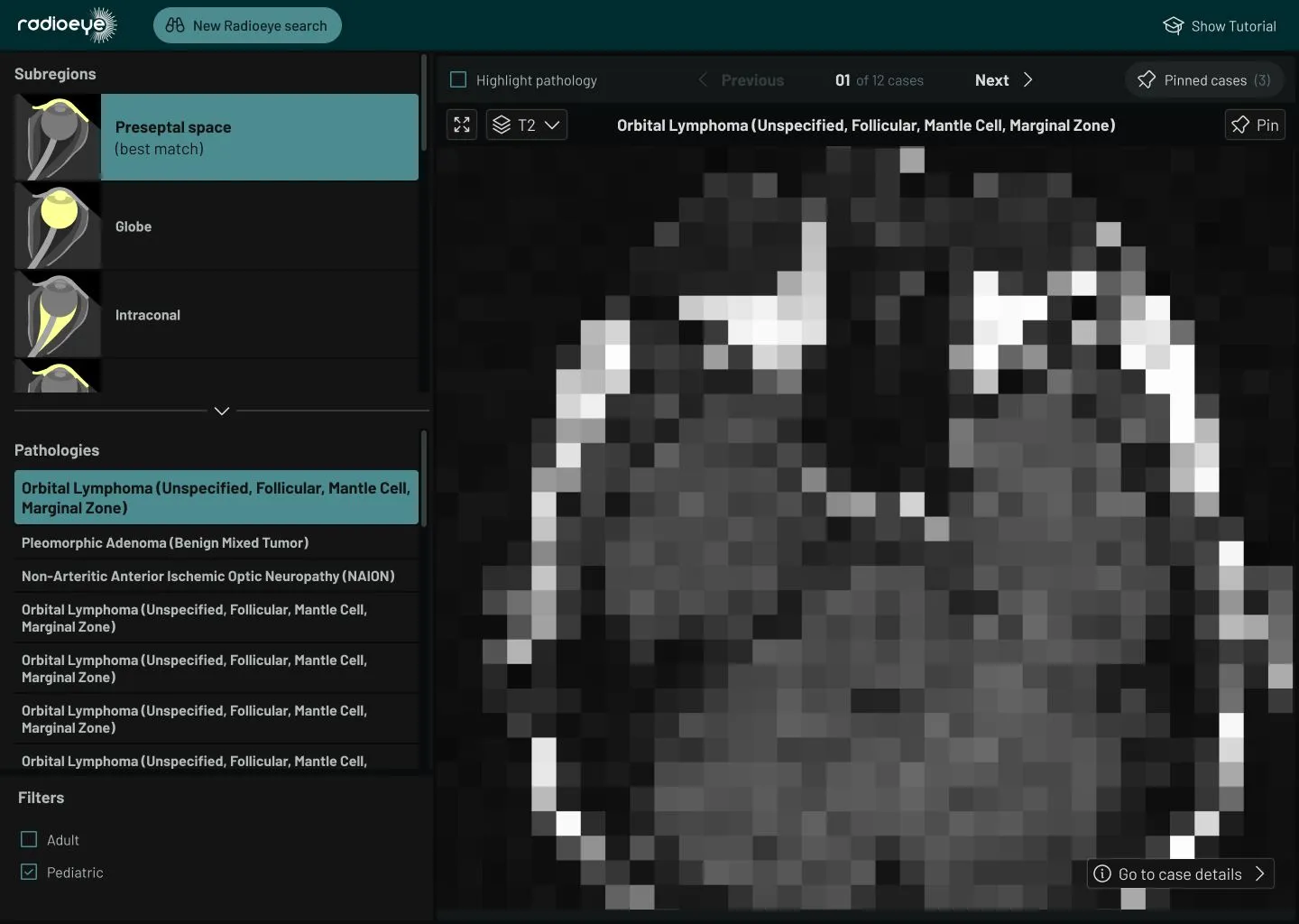 A large MRI scan of a human head, with Ui around it for navigating cases and diagnoses.